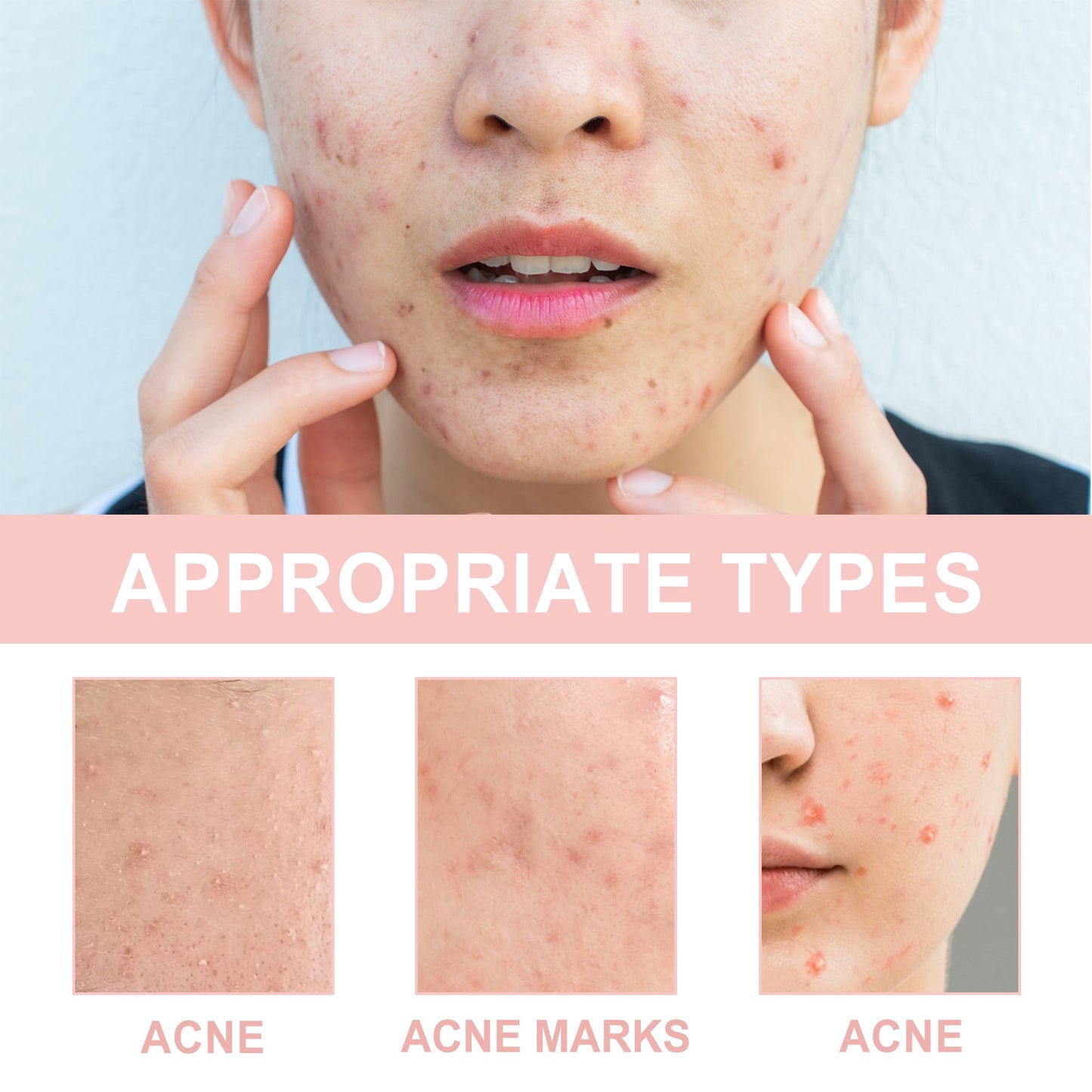 Acne Patch, Repair Acne Pimple Facial Redness Clean Pores Moisturize Skin Patch - DivineLink1 | Electronics, Fitness, Household Essentials | Shop